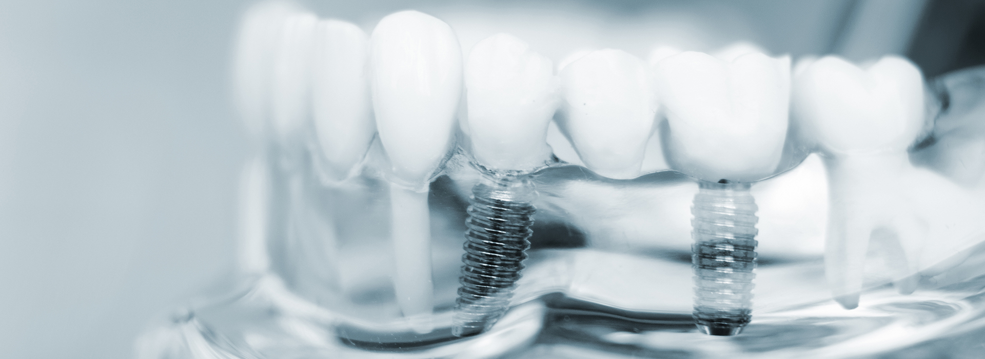 The image shows a close-up of dental implants on a tray with a blurred background.